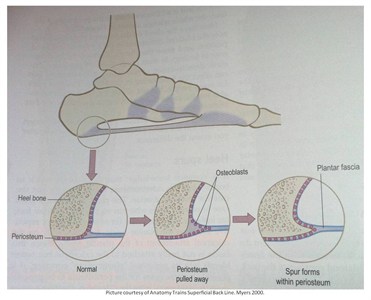 Heel Spur